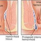 Illustration for article titled obat ambeien alami